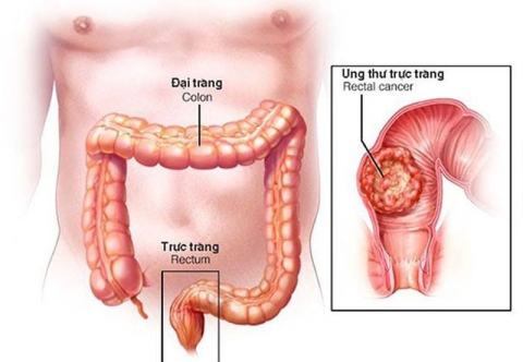 Phẫu thuật điều trị ung thư trực tràng